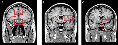 Frontotemporal Dementia and Late-Onset Bipolar Disorder: The Many Directions of a Busy Road